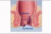 Hemoroid Lapası