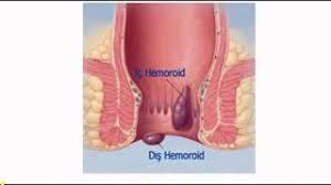 Hemoroid Lapası